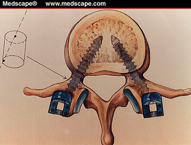 pedicle-screw